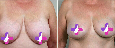 Chirurgie Esthetique Des Seins En Tunisie Photos Avant Apr S