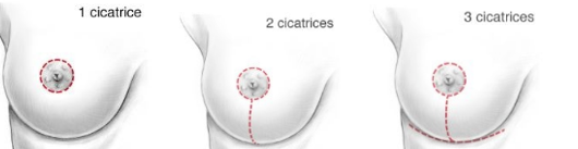 redrapage mammaire en Tunisie 